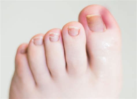 Services Treatments And Common Conditions Morecrofts Podiatry