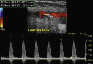 Ultrasound Assessment Of Lower Extremity Arteries Radiology Key