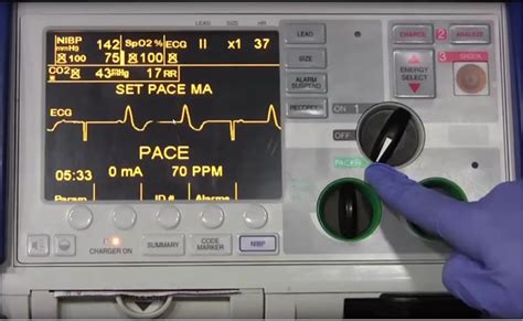 Transcutaneous Pacing — Downeast Emergency Medicine