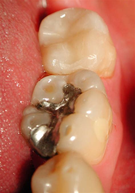 Composite Fillings Deutsche Dental Clinic