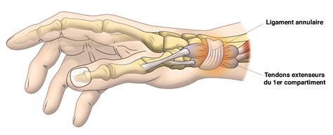 Tendinite De De Quervain Paris Clinique Docteur Gilles Cohen