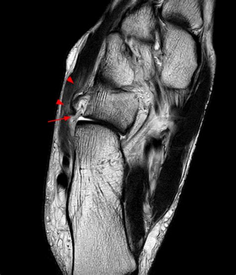 Midtarsal Chopart Joint Sprain Radsource