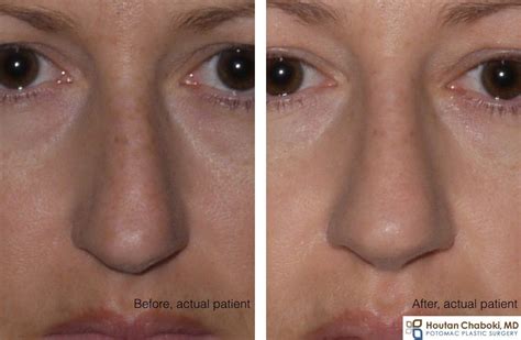 Septoplasty Before And After Pictures Haha Wallpaper