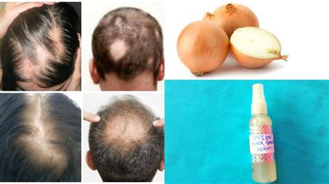 10 Best Treatment For Hair Loss And Regrowth