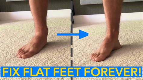 Flat Feet How To Fix Them Forever Youtube