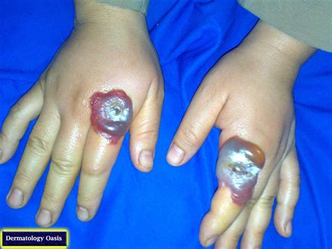 Read about orf, a viral skin disease that can be spread to humans by handling infected sheep and goats. Orf | Dermatology Oasis