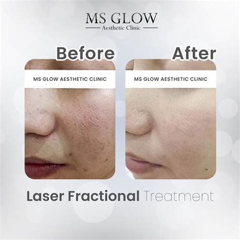 Laser Fractional Treatment MS Glow, Kulit Mulus Bebas Bopeng | TIMES