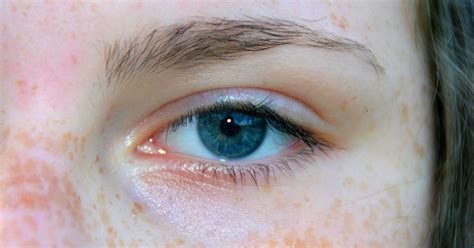Alport S Syndrome Eye
