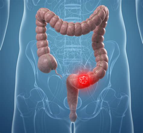 Colorectal Cancer Non Conventional Therapies Peoplebeatingcancer