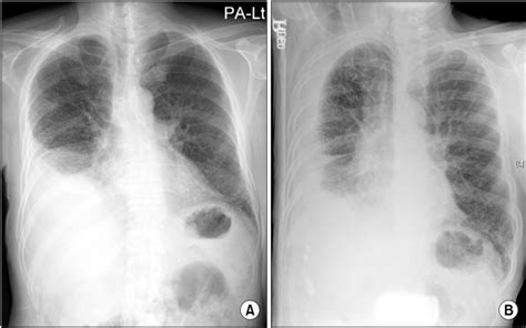 Chest X Ray Chest Poteroanterior A And Right Decubitus View B Show