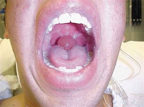 What Causes Uvula To Swell Mastery Wiki