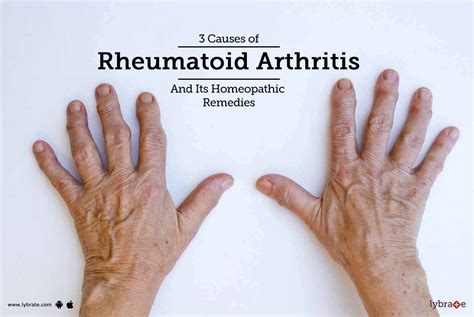 3 Causes Of Rheumatoid Arthritis And Its Homeopathic Remedies By Dr