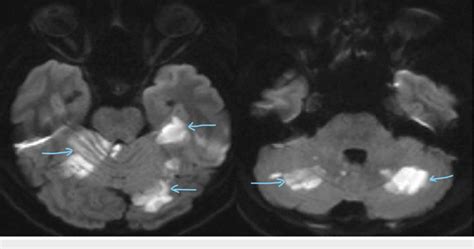 Diffusion Weighted Images Show Acute Infarcts Involving The Left