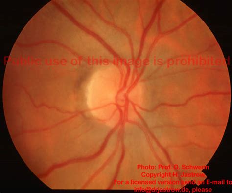Optic Nerve Papilla Clinical Anatomy