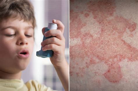 Asthma Atopic Dermatitis May Predispose To Behavioral And Emotional