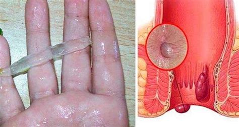 Maybe you would like to learn more about one of these? THIS IS THE BEST NATURAL CURE FOR HEMORRHOIDS! EVEN THE ...