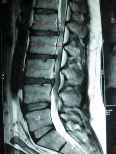 Redefining Lumbar Spinal Stenosis As A Developmental Syndrome An Mri