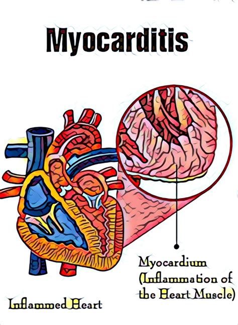 Myocarditis can affect your heart muscle and your heart's electrical system, reducing your heart's ability to pump and causing rapid or abnormal heart. Myocarditis: Symptoms Causes, Possible Complications, And Ways To Reduce The Risk Of Getting It