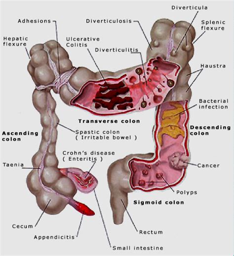 the health website bowel colon colorectal cancer