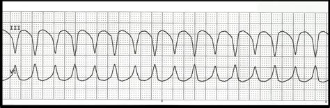 Se non trattata porterà a fibrillazione ventricolare. Float Nurse: Pulseless VF/VT Part 1