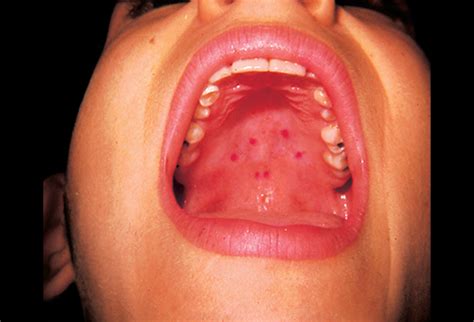 It rarely affects teenagers and adults who usually show milder symptoms. Hand, foot and mouth disease. Causes, symptoms, treatment ...
