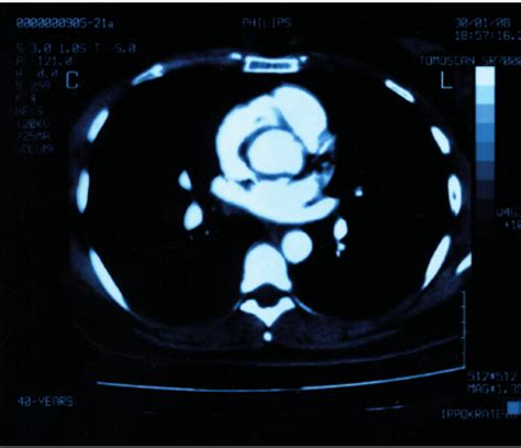 Spiral Ct Scan Image Showing Normal Lung Vas Culature Download