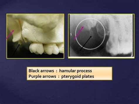 Normal Radiographic Anatomical Landmarks Ppt