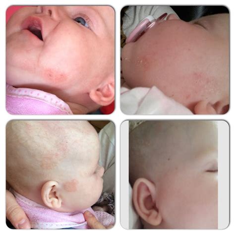 Efforts to win hearts and. Before and after of baby Chloe's eczema after using the ...