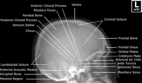 Radiographic Anatomy Skull Lateral Medical Pinterest