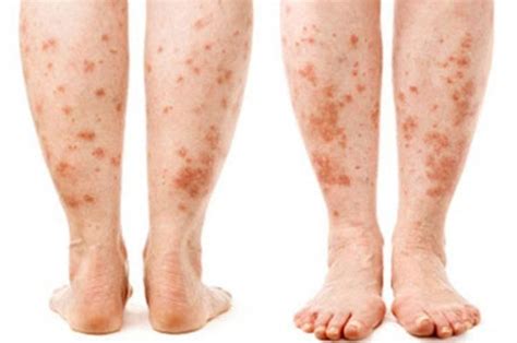 Can Leggings Cause Rash On Skin