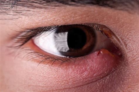 Styes Causes Home Remedies Medical Treatment And Symptoms