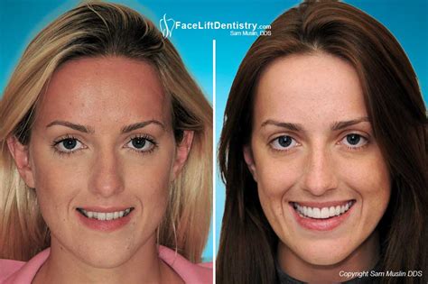 In the article you will find out 4 different ways. Adult Crossbite Correction Without Braces