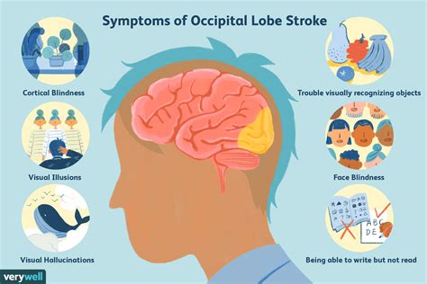 Los Efectos De Un Accidente Cerebrovascular En El Lóbulo Occipital