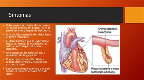 Get what is a thrombosis Trombosis coronaria