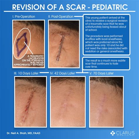 Surgical Revision Of A Scar Of A Pediatric Patient Clarus Dermatology