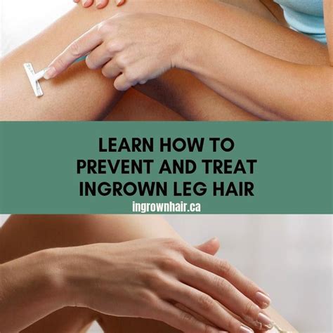 Ingrown pubic hairs are common for women who groom around their vagina and bikini area. How to treat and prevent ingrown leg hairs - June 25, 2019 ...