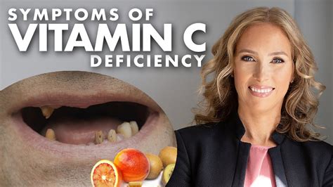 Symptoms Of Vitamin C Deficiency Dr J Live Youtube
