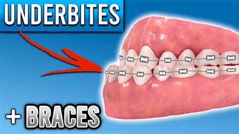 How Do Braces Fix Underbites Premier Orthodontics Youtube
