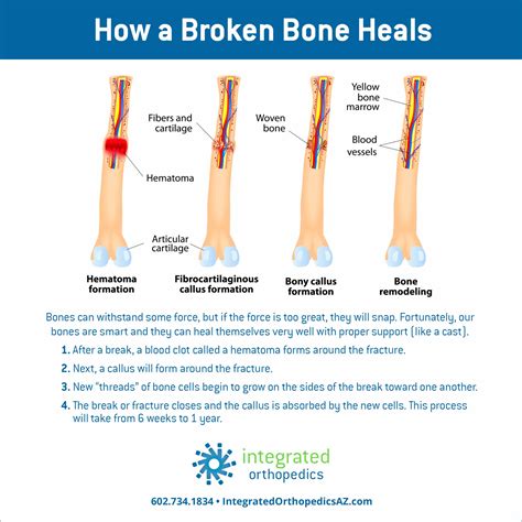 Broken Humerus Bone Healing Stages