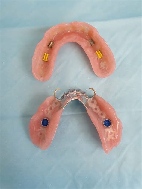Implant Dentures Partial