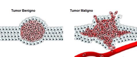 ¿qué Es Un Tumor Benigno Curiosoando