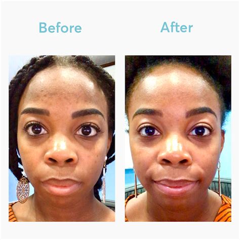 Hydroquinone Before And After Black Skin