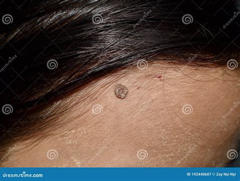 Intradermal Nevus Or Single Mole At The Forehead Of Southeast Asian
