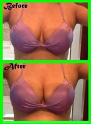 Best Cosmetic Hospitals Non Surgical Breast Lift