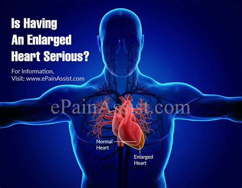 Pin By Soumyag On Enlarged Heart Enlarged Heart Enlarged Normal Heart
