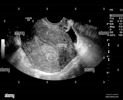 Endometrial Polyp Ultrasound Scan Of The Uterus Womb Of A 42 Year