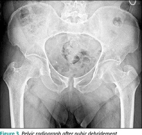 Figure 1 From Management Of Osteomyelitis Of The Pubic Symphysis Following Urinary Fistula In