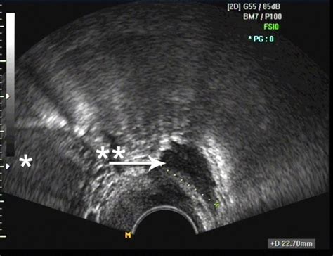Diagnose und behandlung von endometriose. Tief infiltrierende Endometriose (TIE)