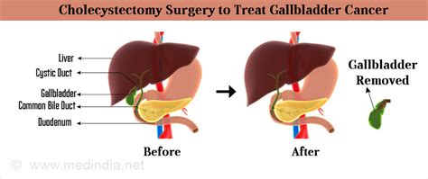 Gallbladder Cancer Types Causes Symptoms Diagnosis Treatment