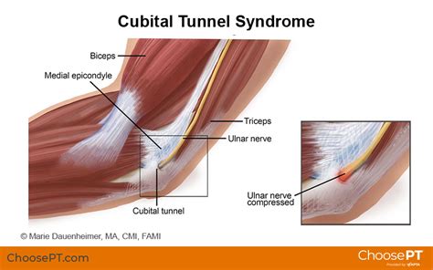 Guide Physical Therapy Guide To Cubital Tunnel Syndrome Choose Pt